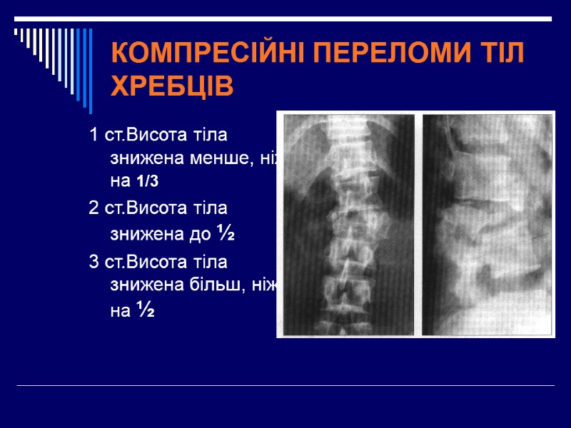 КОМПРЕСІЙНІ ПЕРЕЛОМИ ТІЛ ХРЕБЦІВ  1 ст.Висота тіла знижена менше, ніж на 1/3 2